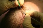 Hair Transplant Treatment Center In India