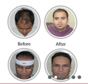 Best hair loss treament with hair transplant surgery in India