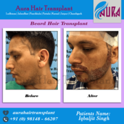 Beard Transplant in Ludhiana Punjab